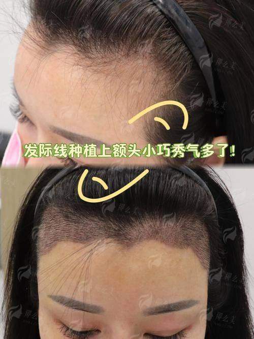 三、贵州黔南菲梵医美的发际线种植术后成效自然吗？