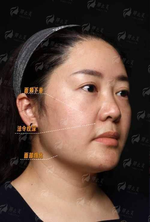 二、西安国内外李高峰面部提升适合你吗？对照这4类人