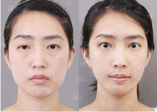 二、广州曙光阮庆玲医生双眼皮特殊设计理念