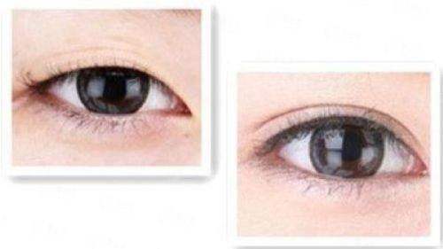 二、苏州薇琳埋线双眼皮价格贵吗？附同城对比