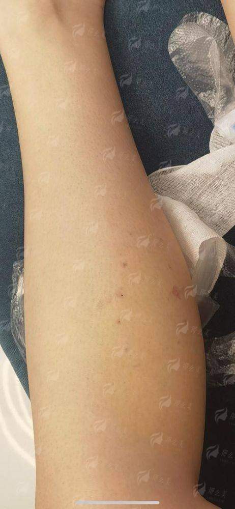 一、南通韩秀医疗美容瘦腿针是什么原理？