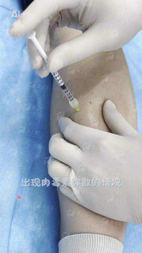 二、南通韩秀医疗美容瘦腿针有什么特殊优势？