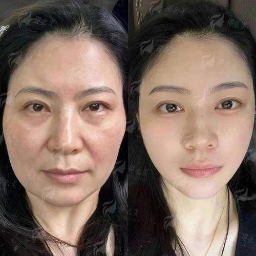 三、北京加减美穆宝安面部提升价格贵吗？和国有医院对比