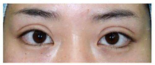 二、深圳米兰柏羽黄海燕医生双眼皮技术特色