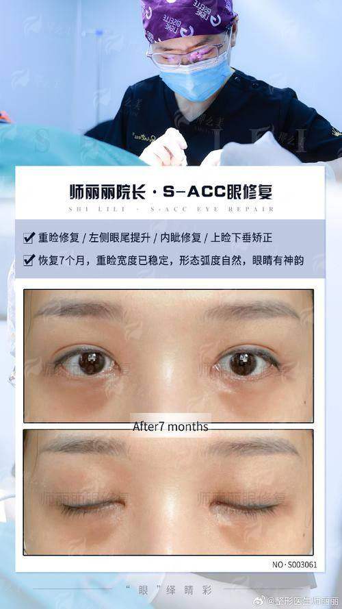 佀同帅眼修复价格贵不贵？上海华美真实案例分享，附医生预约方式！