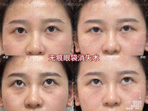 深圳美博瑞祛眼袋效果对比：内切vs外切vs激光，哪种更自然？