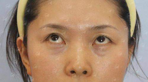 二、深圳美博瑞三种祛眼袋方式成效大比拼