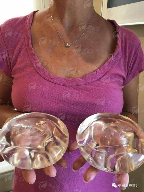 二、深圳比奥芳华自体脂肪隆胸真人实例实录