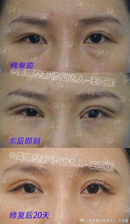 深圳米兰柏羽黄海燕割双眼皮靠谱吗？双眼皮技术特色！附24小时预约通道赶紧了解！