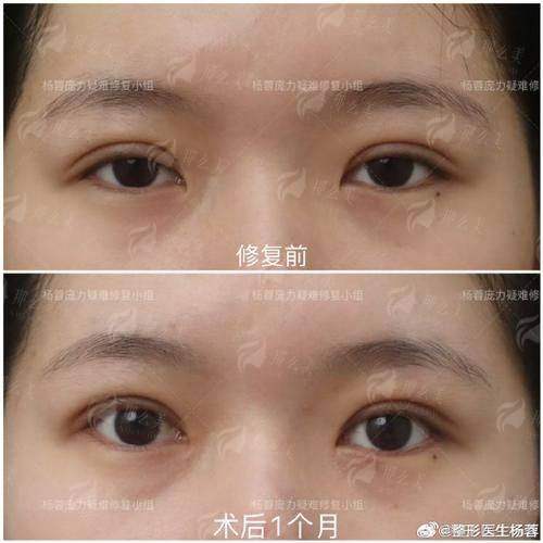 六、深圳米兰柏羽双眼皮手术价格透明度