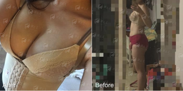 四、北京纯脂医疗美容门诊部双眼皮价格解析