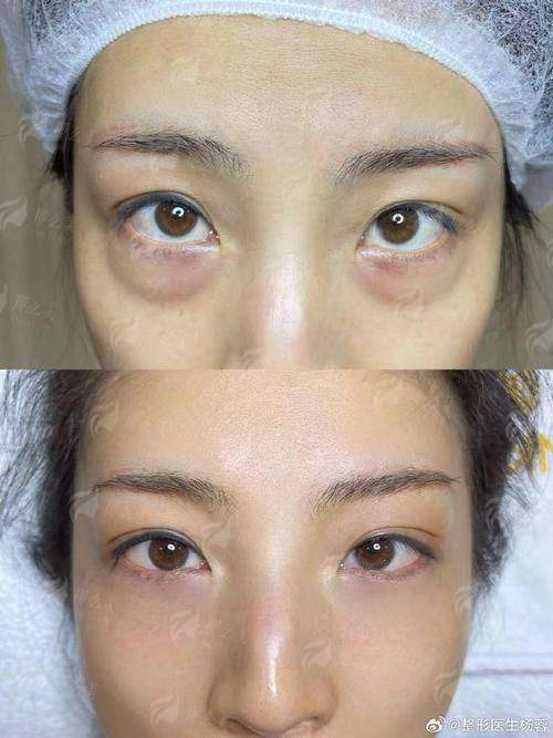 二、湖北宜昌亚太整形美容医院祛眼袋价格贵吗？