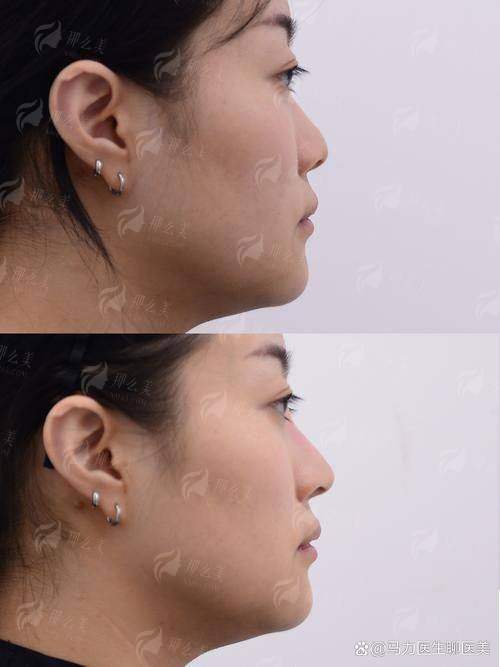 一、湖北中爱整形的假体隆鼻医生技术强在哪？