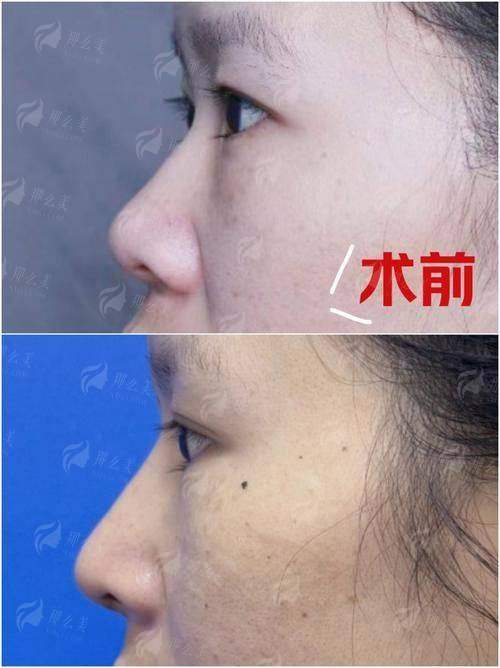 三、熊国安医生隆胸手术有哪些特色？