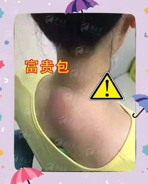 四、深圳比奥芳华门诊部怎么预约富贵包微创术？