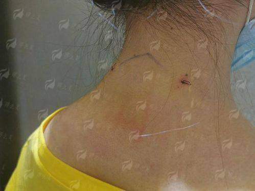 二、深圳比奥芳华门诊部做富贵包微创术有哪些保护？