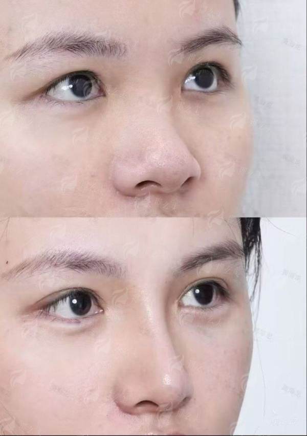 提眉手术哪家强？荆门京山伊莱美整形真实案例对比，效果太惊艳！