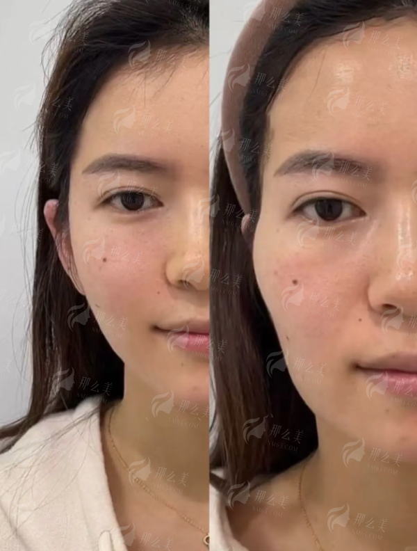 想了解上海华美刘学新拉皮技术？全面解析+真实案例分享，坐诊地址及预约挂号方式全公开！