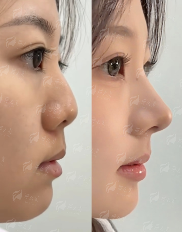 二、兴华医院隆胸项目价格贵不贵？