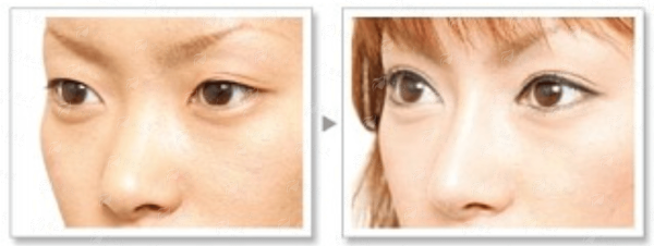 三、上海艺星医疗美容医院（长宁院）发际线种植真实实例分享