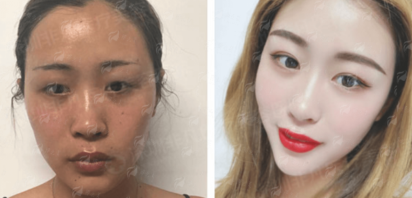 三、深圳非凡医疗美容隆胸价格贵不贵？