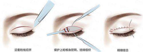 <strong>四、南昌东方薇琳整形双眼皮值得选吗？</strong>