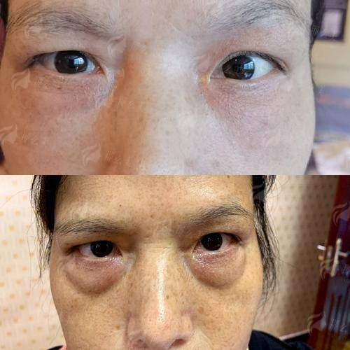 和平妇产医院祛眼袋价格贵吗？2026最新收费表+术后效果全公开！