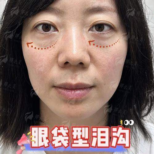 二、武汉五洲陶娅线提升术后成效真实反馈