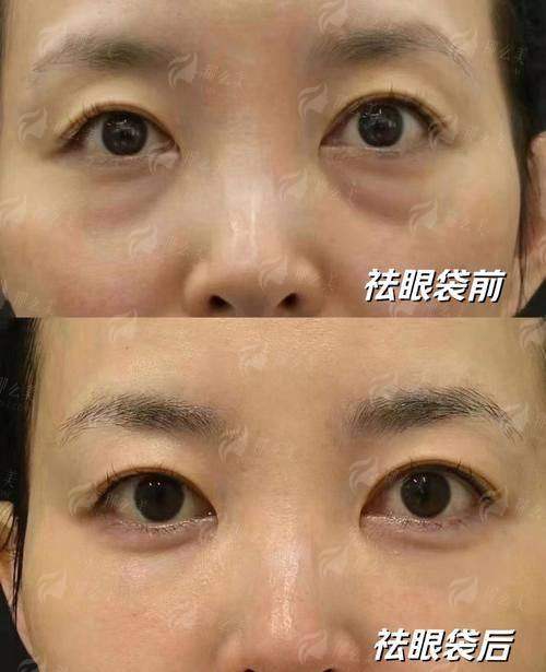三、广东惠州稚美医疗美容祛眼袋术后成效如何？