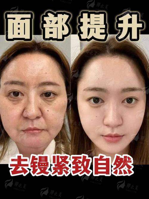 三、郑州喜丽小切口拉皮价格贵吗？附同城对比