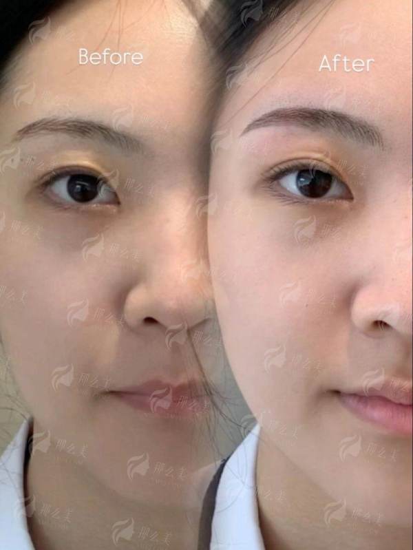 东莞隆鼻口碑医院推荐！壹加壹、美立方、华美、紫芯价格技术全解析