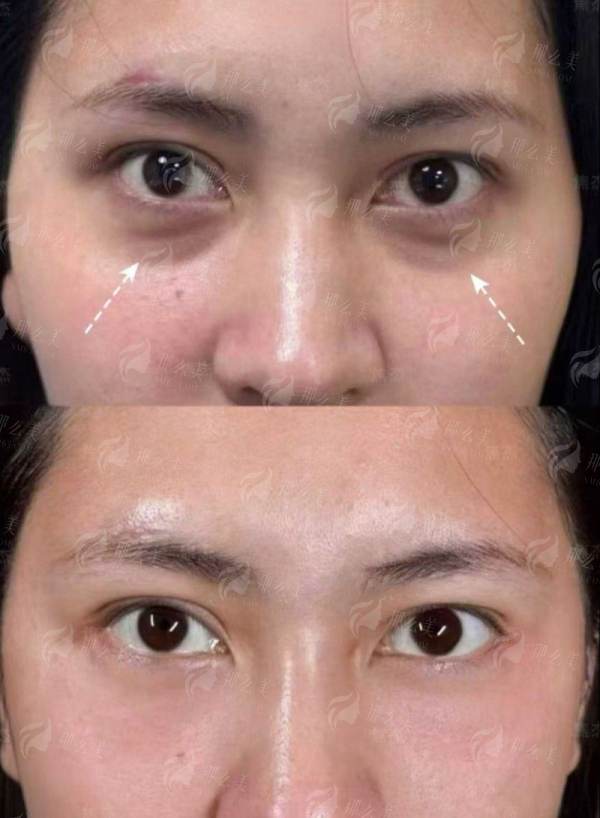 二、广东惠州稚美医疗美容祛眼袋医生团队有哪些特色？