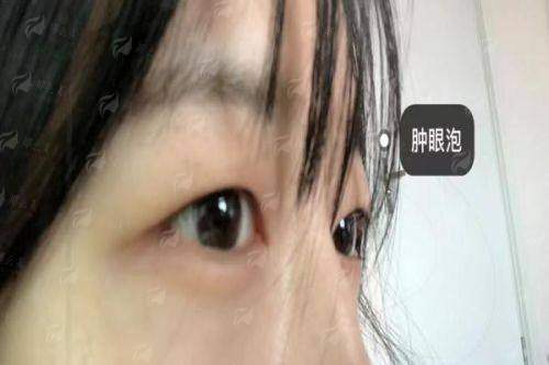 一、太原军大杨长征和白继平双眼皮技术风格对比