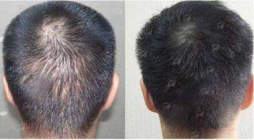 一、哈尔滨臻美全身吸脂成效真实吗？真人实例对比图曝光