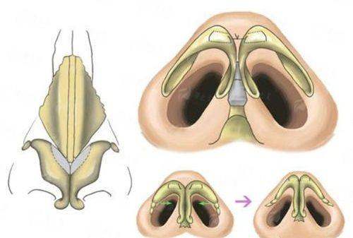 成都西区鼻修复价格对比：邓东伟和段焘技术解析，附预约方式！