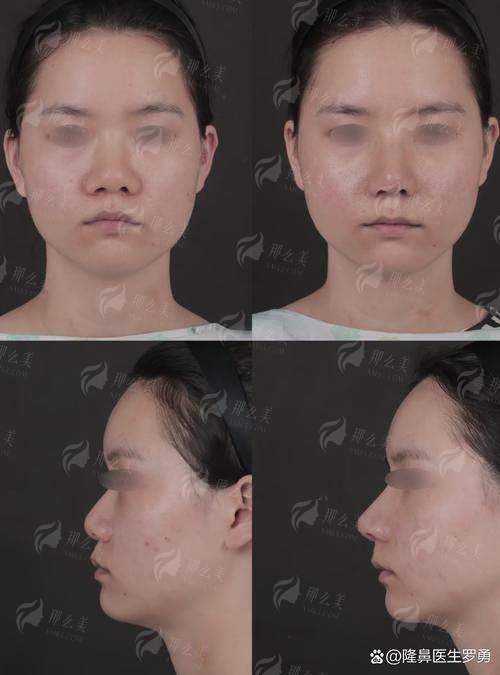 陈天杰隆鼻技术好在哪？南京艺星医生特色+术后效果对比，避坑必看！