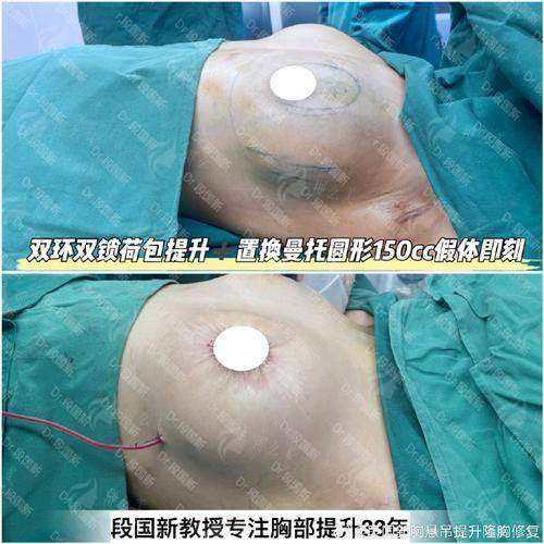 三、昆明隆胸医生怎么选？骨干医生技术解析