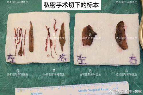 石家庄雅芳亚张雪梅和吴小玉医生私密整形价格对比！附真实案例效果分享