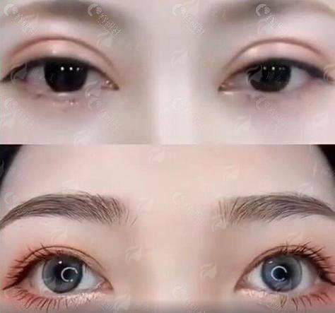 三、王自谦医生：仿生双眼皮的开拓者