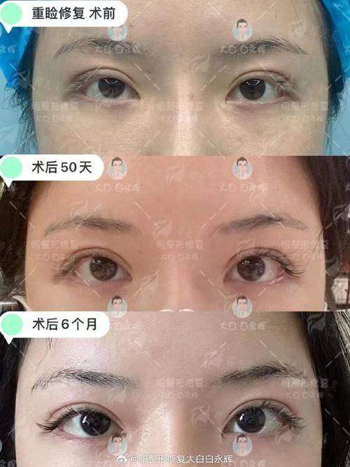 哇塞！北京纯脂医疗美容门诊部特色双眼皮手术，孙泽芳和王自谦谁做的双眼皮最自然？附预约方式！