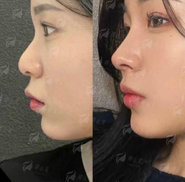 二、南京艺星陈天杰隆鼻术后成效如何？真人实例对比