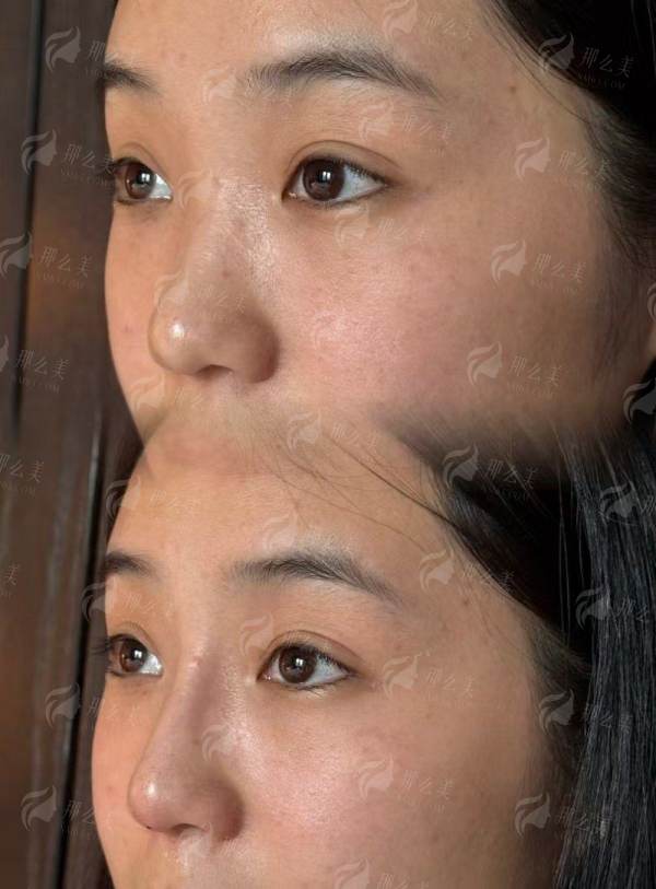 三、成都西区邓东伟vs段焘鼻修复该怎么选？