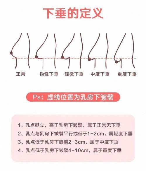 亳州康美整形——程淑芹丰胸真实案例全公开！术后效果对比看，附到院地址