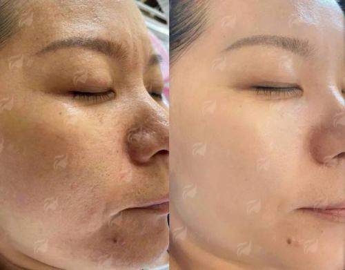 二、南通星际祛斑祛痘价格贵吗？对比表来了