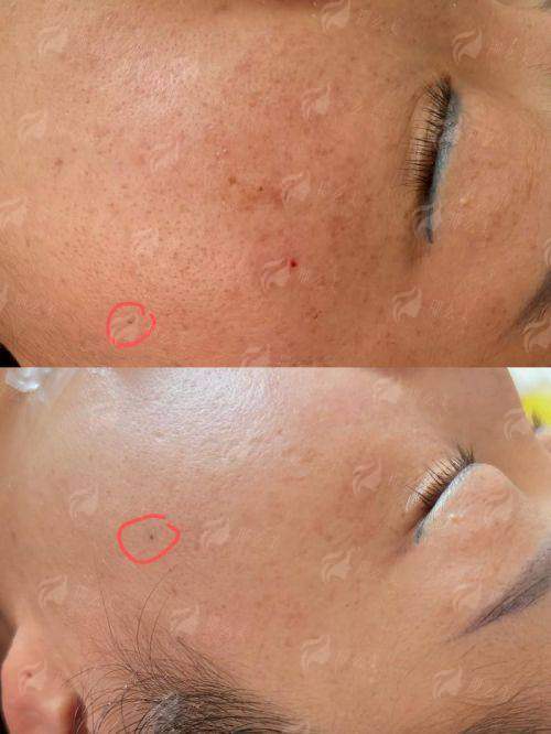 三、星际祛斑祛痘术后要注意什么？