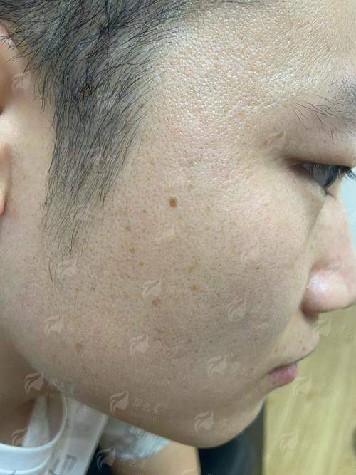 南通星际医疗美容祛斑祛痘效果怎么样？真实案例全解析，价格对比看这里！