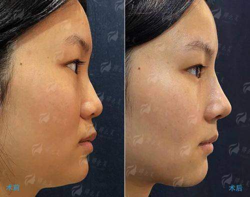 二、东莞美立方美容医院的隆鼻口碑为什么好？