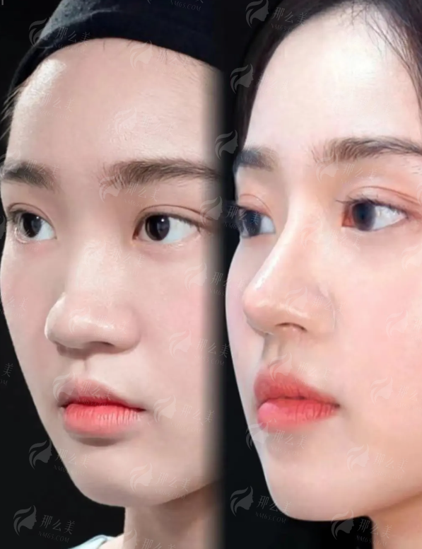 三、东莞华美医疗美容医院的网红鼻有何特色？