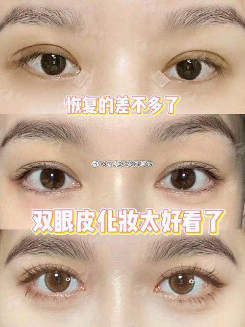 三、苏州紫馨美容医院的双眼皮手术有什么优势？