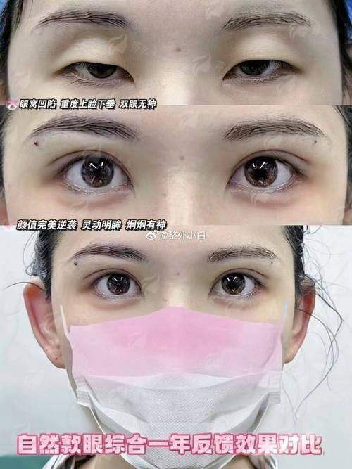 二、苏州美贝尔美容医院的双眼皮手术技术好吗？